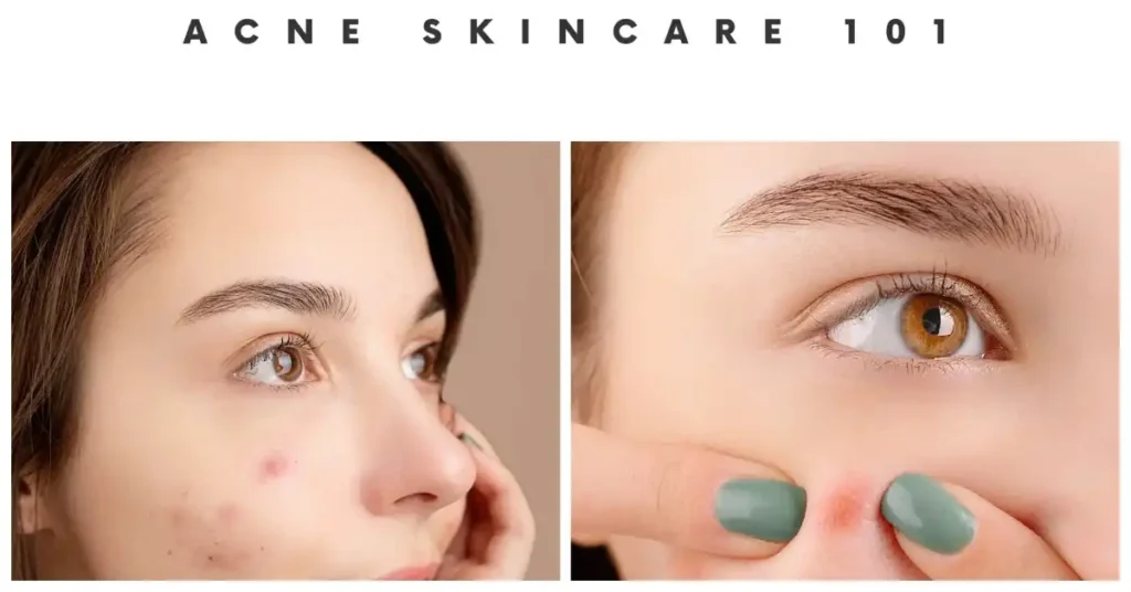 acne clearskinstudy