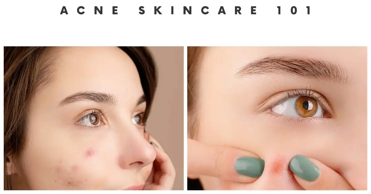 acne clearskinstudy