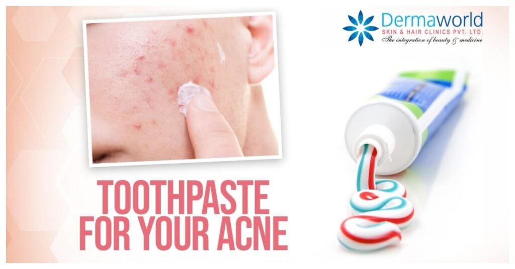toothpaste on acne