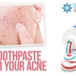 toothpaste on acne