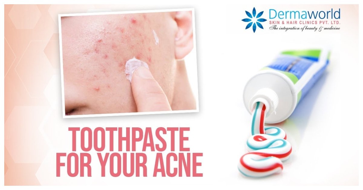 toothpaste on acne